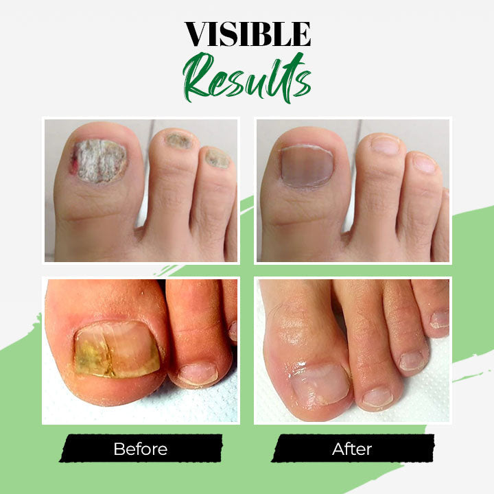 Fungal Nail Treatment Essential Oil