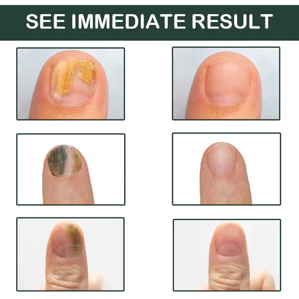 LifeMed Home Use Onychomycosis Fungus Laser Treatment