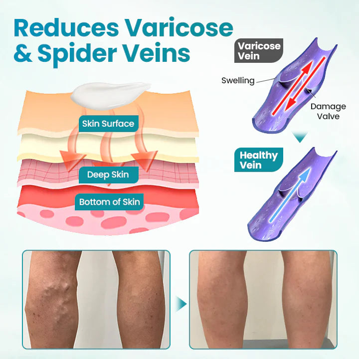 ✅Croaie® VeinAway Relief Cream