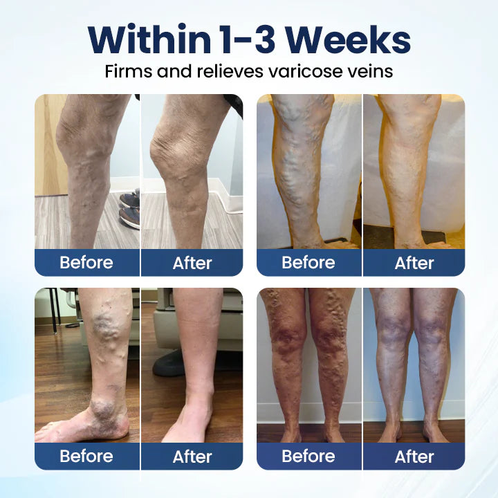 Timilk® Deep Vein Repair Microneedle Patch