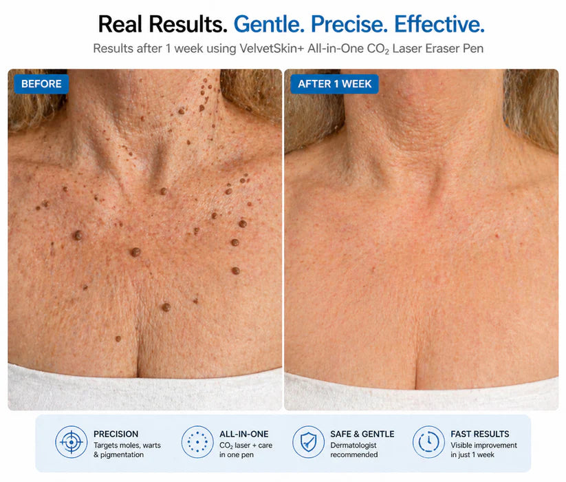 LUMIVO™ All-in-One CO₂ Laser Eraser Pen | Removes Moles, Warts, Skin Flaws & Pigmentation