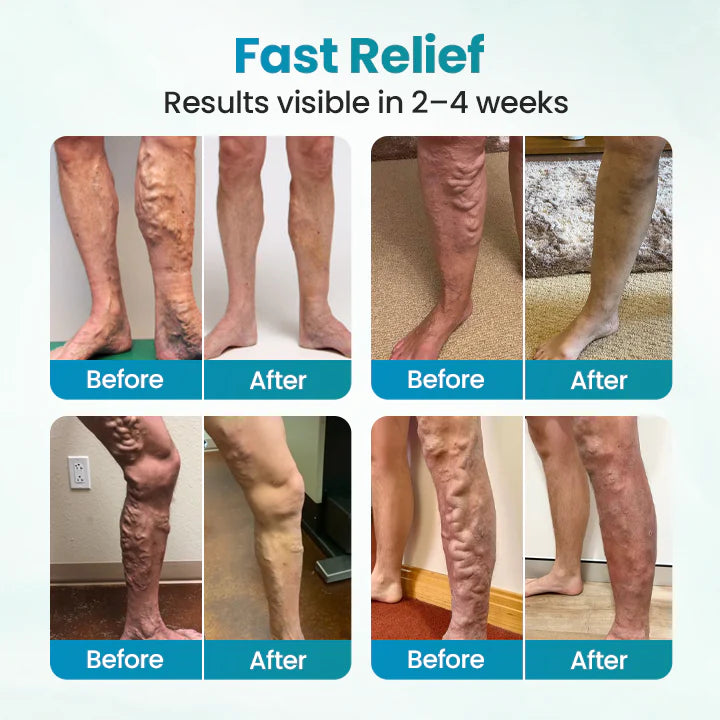 ✅Croaie® VeinAway Relief Cream