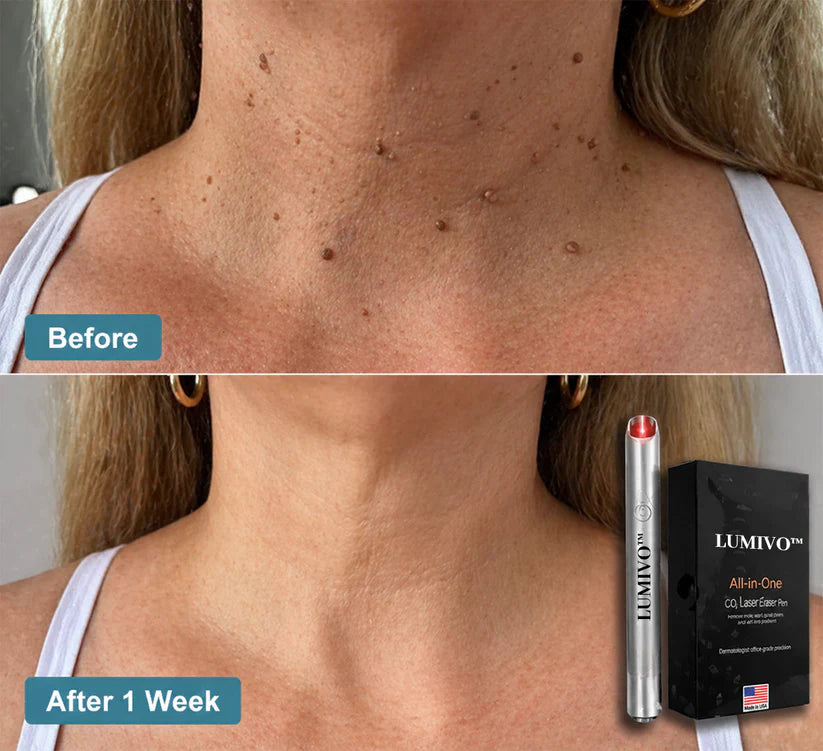LUMIVO™ All-in-One CO₂ Laser Eraser Pen | Removes Moles, Warts, Skin Flaws & Pigmentation