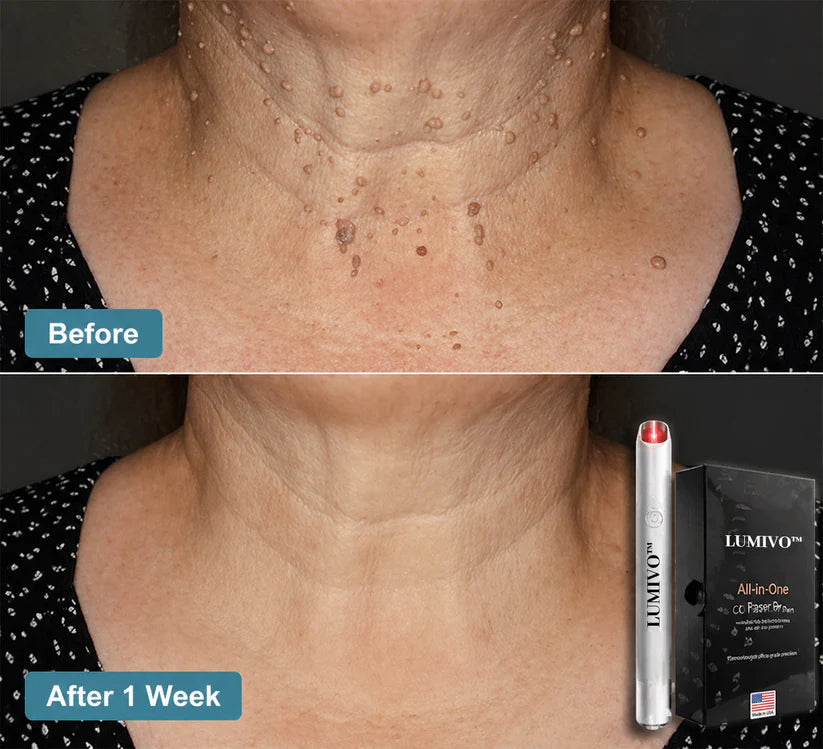LUMIVO™ All-in-One CO₂ Laser Eraser Pen | Removes Moles, Warts, Skin Flaws & Pigmentation