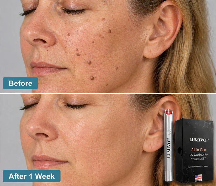 LUMIVO™ All-in-One CO₂ Laser Eraser Pen | Removes Moles, Warts, Skin Flaws & Pigmentation