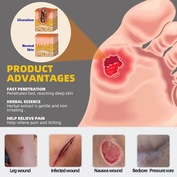 Bedsore cream-Decubitus ulcer treatment cream to solve your worries🔥