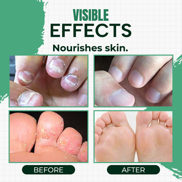 Hand Ringworm Beriberi Fungus Spray