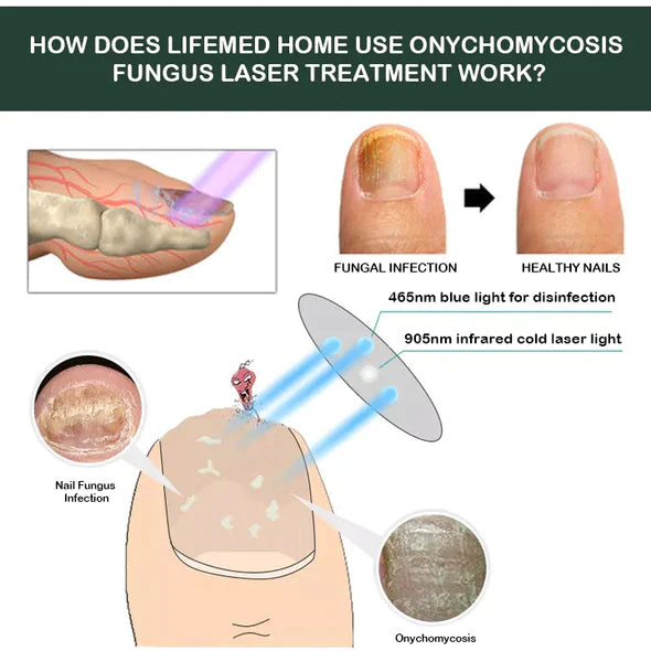 LifeMed Home Use Onychomycosis Fungus Laser Treatment