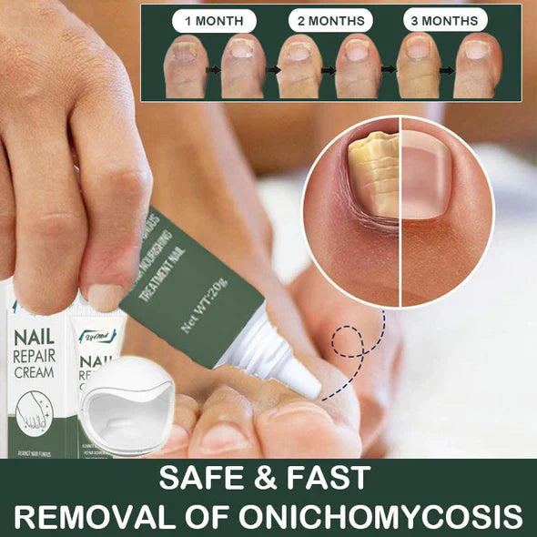 LifeMed Home Use Onychomycosis Fungus Laser Treatment